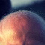 کمبود خواب و ریزش مو