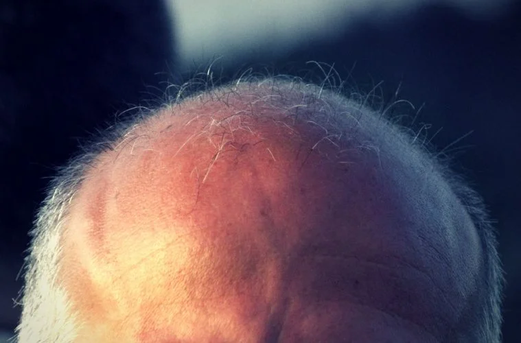 کمبود خواب و ریزش مو